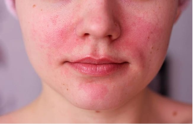  طرق علاج إكزيما الوجه وأنواعها